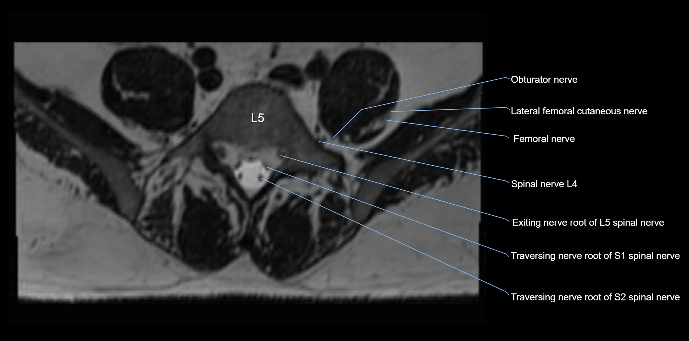 MR lumbosacral plexus axial cross sectional anatomy 3T  radiology  image-img-1008001-00055.webp